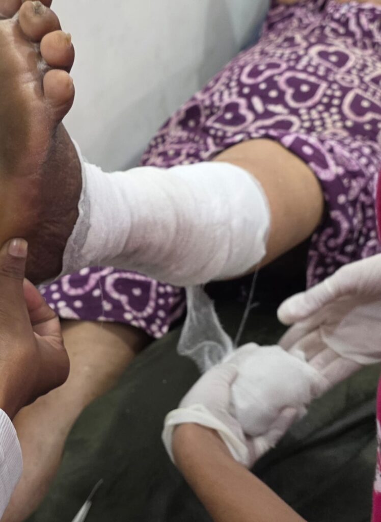 Diabetic foot management at Swasthya Hospital to prevent nerve damage.