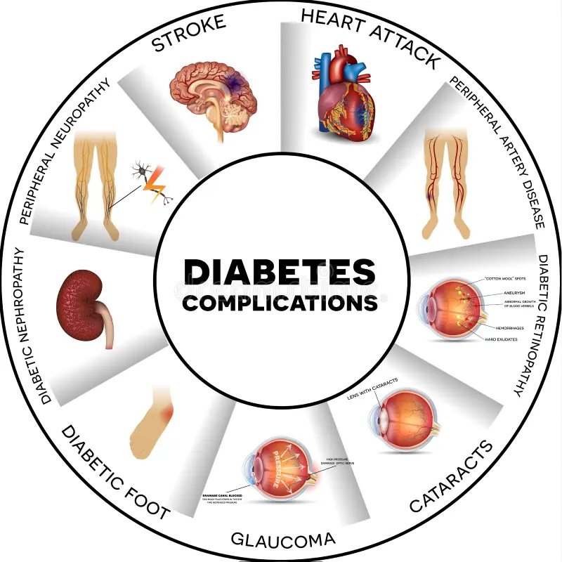 "A circular medical infographic titled 'Diabetes Complications' illustrating eight major health risks: Stroke (brain), Heart Attack (heart), Peripheral Artery Disease (legs), Diabetic Retinopathy (eye damage), Cataracts (cloudy eye lens), Glaucoma (eye pressure), Diabetic Foot (foot ulcer), Diabetic Nephropathy (kidney damage), and Peripheral Neuropathy (nerve damage in legs)."
