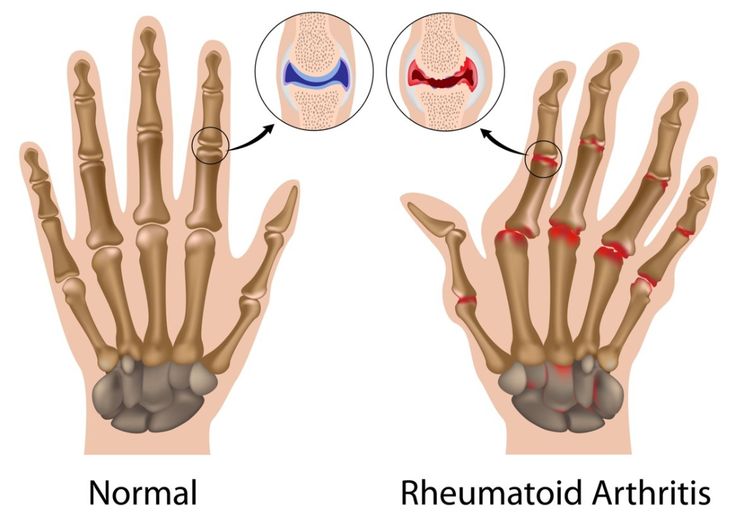 rheumatoid arthritis
