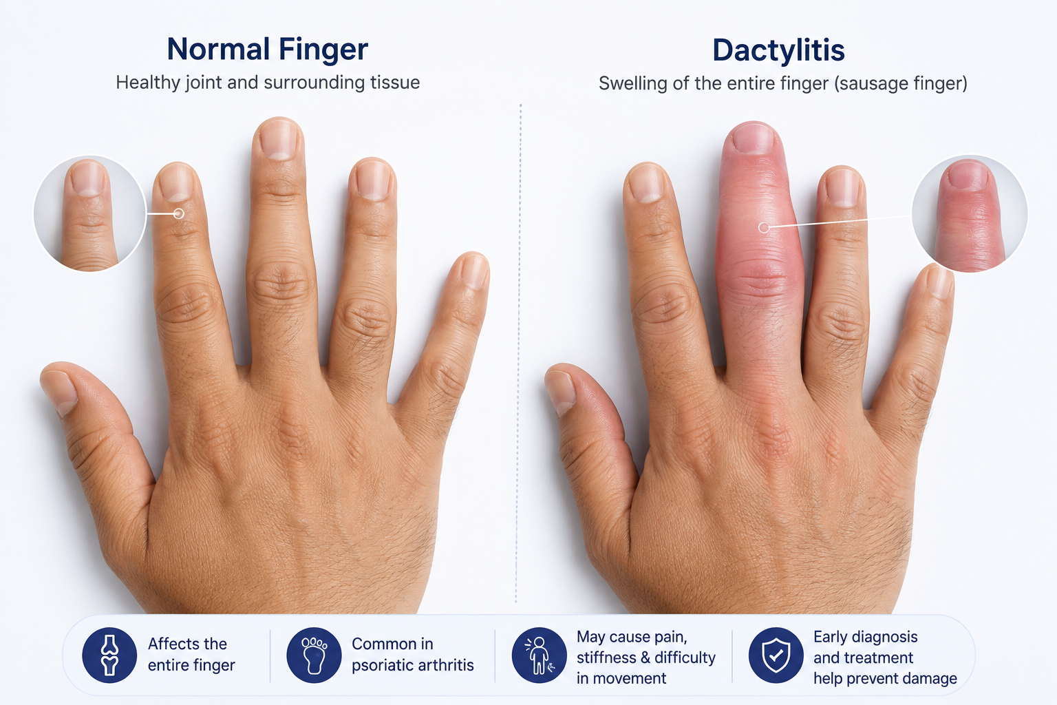 Illustration comparing a healthy finger joint to one affected by dactylitis and swelling